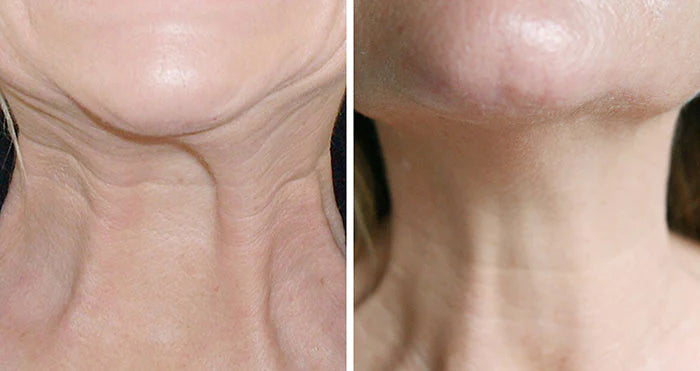 GOPUCE Miracle Neck Cream: Borra las líneas de “cuello de pavo” y “cuello tecnológico”. Elevación visible y suavidad en 4 semanas.
